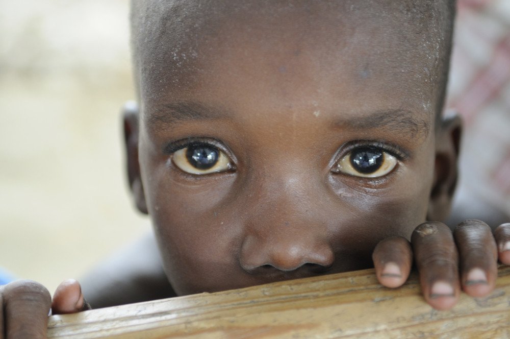 Poor African Children Face Malnutrition Risk, Whilst Rich Kids Become Obese