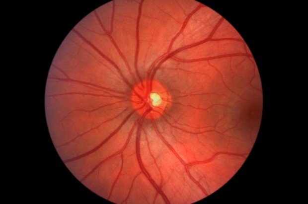 macular degeneration