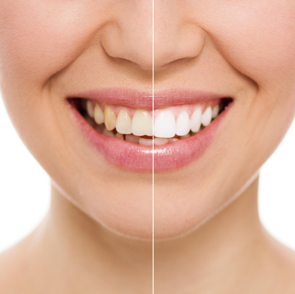 The Advantages Of Cosmetic Dentistry and Approximate Costs In North America