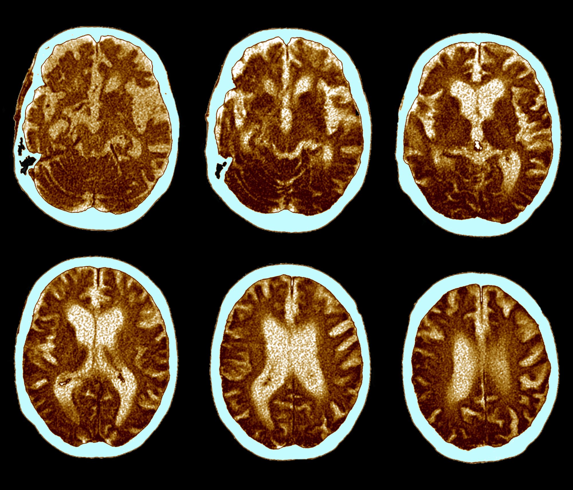 neurological-disorders-and-how-they-can-affect-you-longevity-live