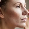 adult acne | Longevity Live