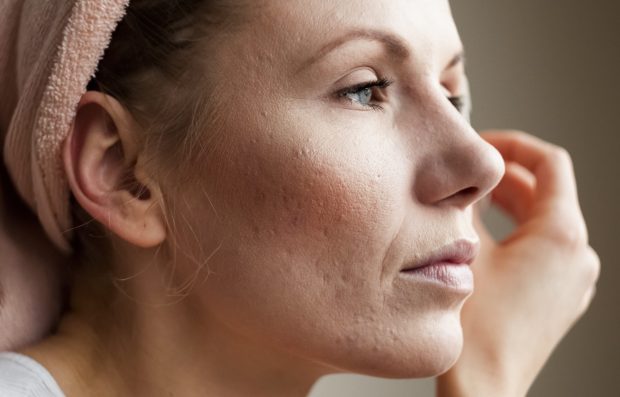 What You Need To Know About Adult Acne Longevity Live