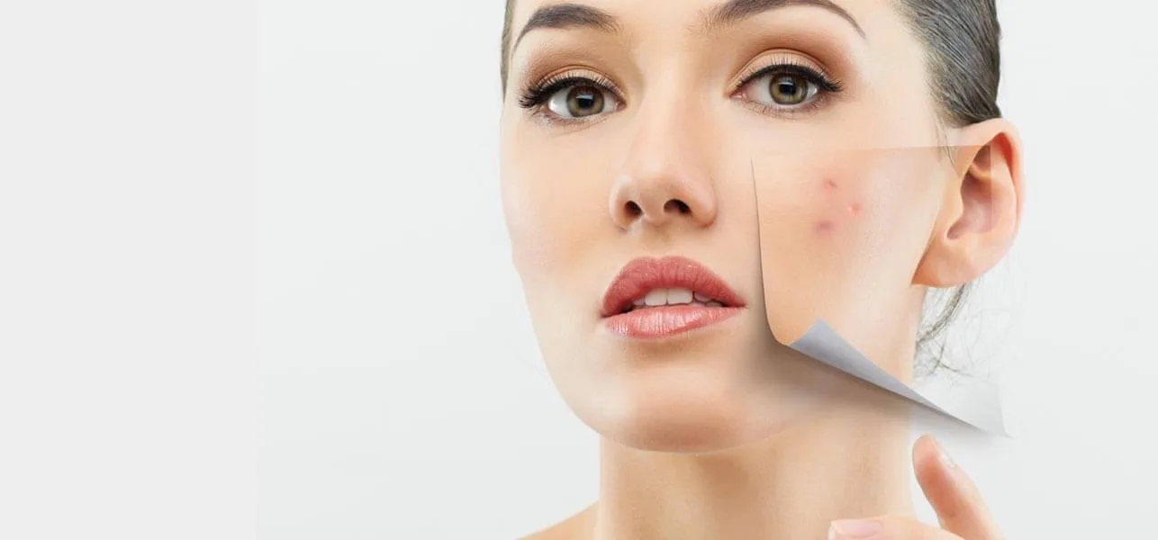 Vitamin D: Could It Be The Solution To All Your Acne Woes?