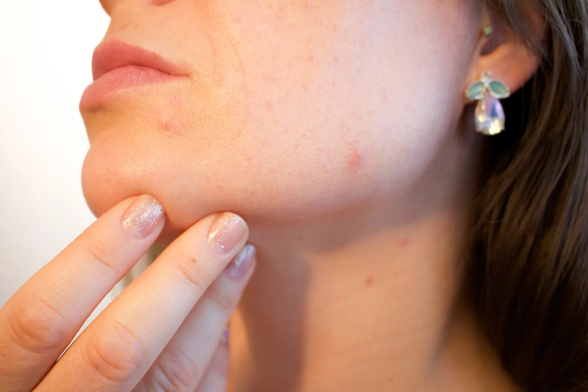 13 Things You Should Do When Your Acne Does Not Clear