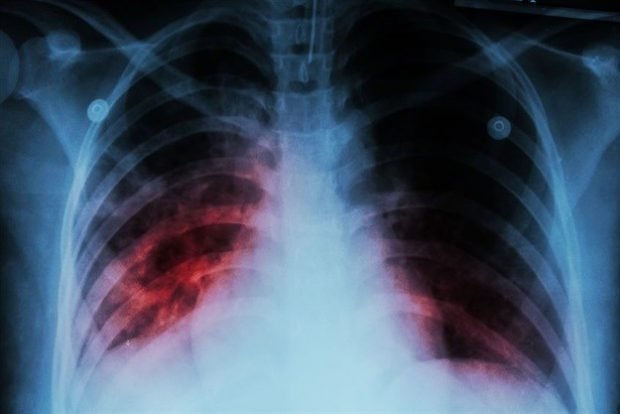 Tuberculosis study
