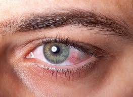 laser vision correction dry eyes