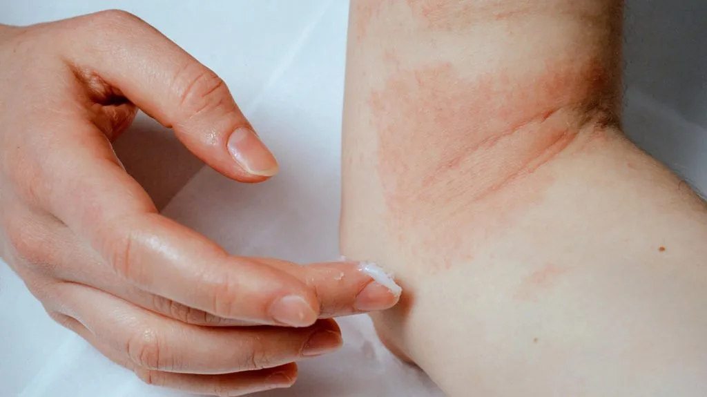 World Atopic Eczema Day: More Than #skindeep