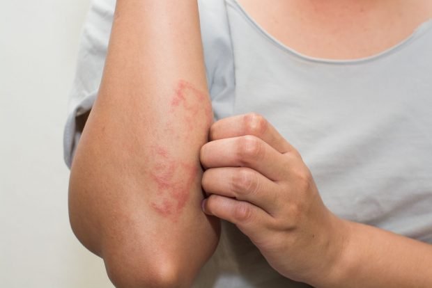 eczema | Longevity LIVE