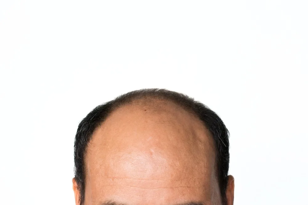 receding hairline | Longevity LIVE