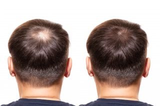 Finasteride For Hair Loss: Should You Try It? - Longevity LIVE