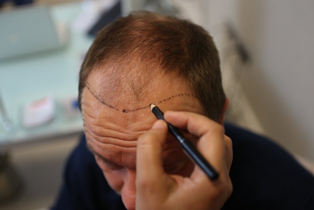 hair transplant | Longevity LIVE
