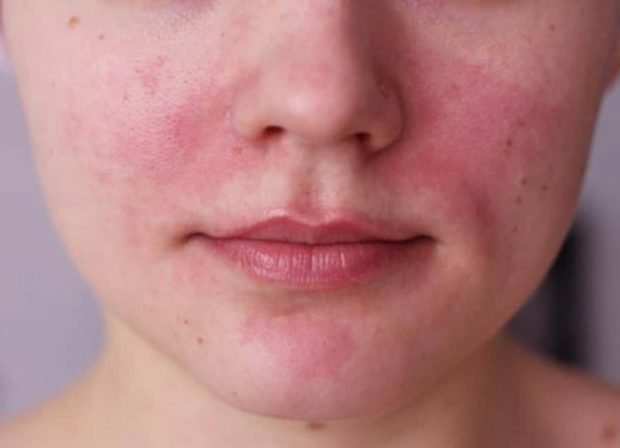 rosacea skin