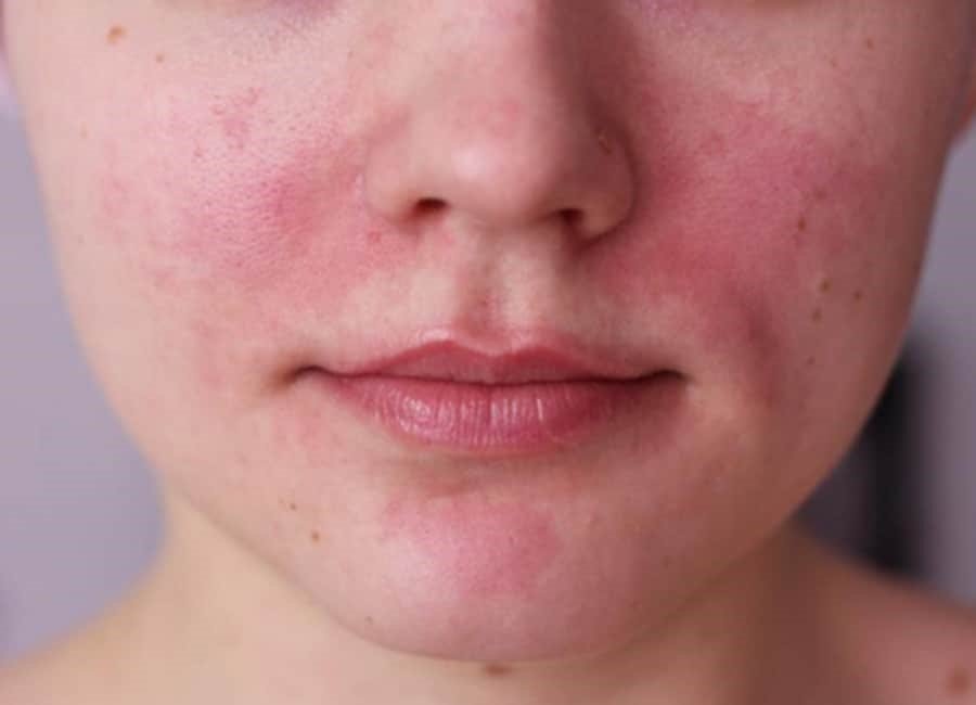 Rosacea: What is it and is it treatable?
