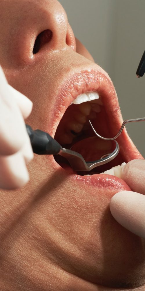 teeth sensitivity