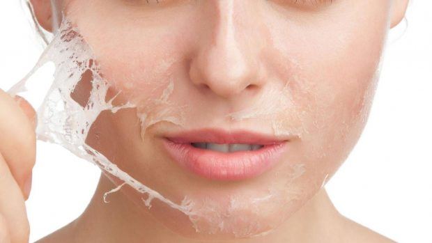 chemical peel