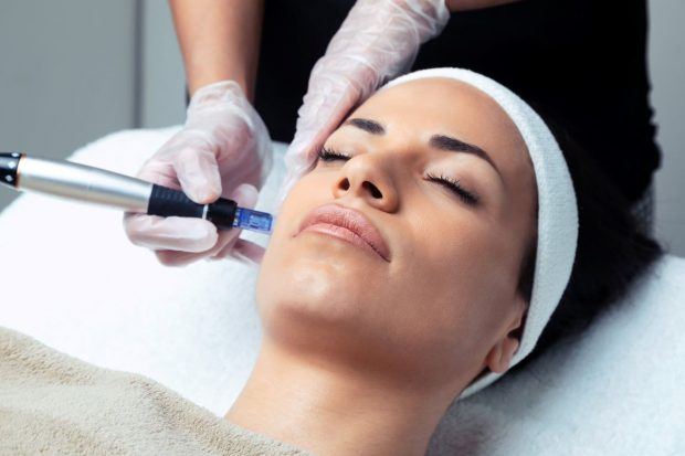 microneedling