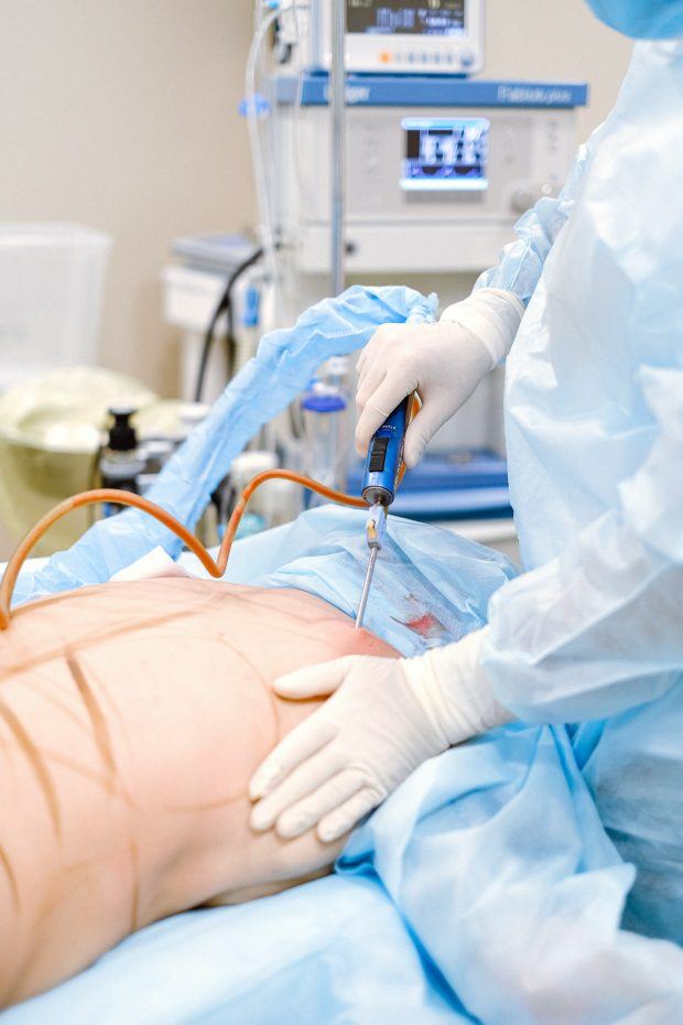Liposuction