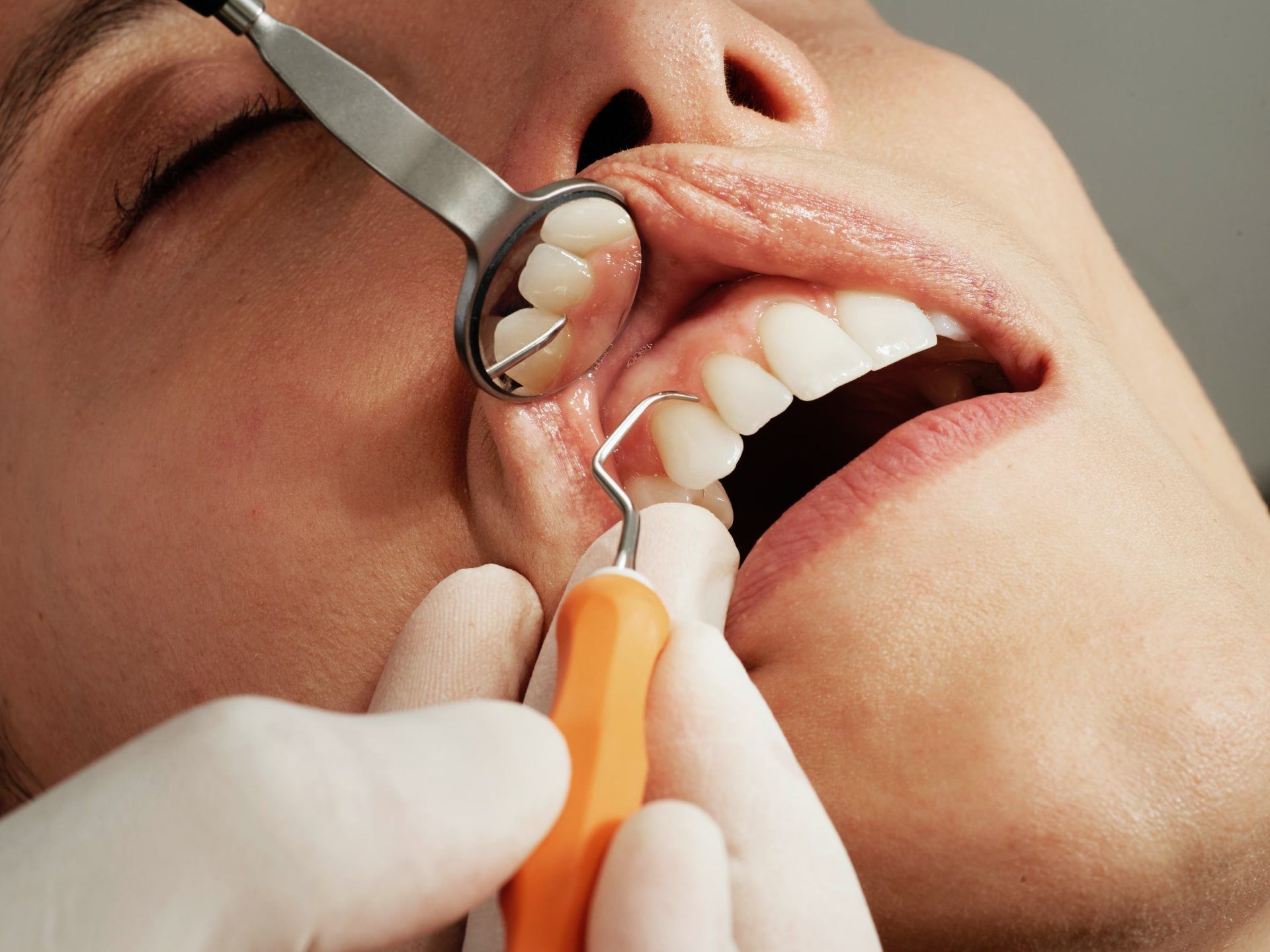 Dental Implants: 3 Techniques That You Should Know