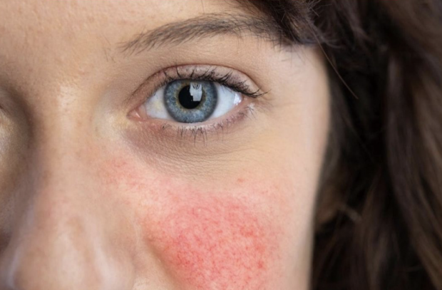 rosacea