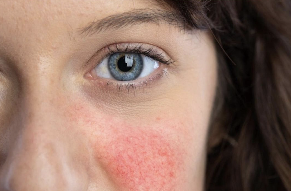 Here’s What Might be Triggering Your Rosacea Flare Ups