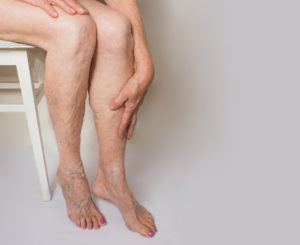 What Happens If Varicose Veins Are Left Untreated