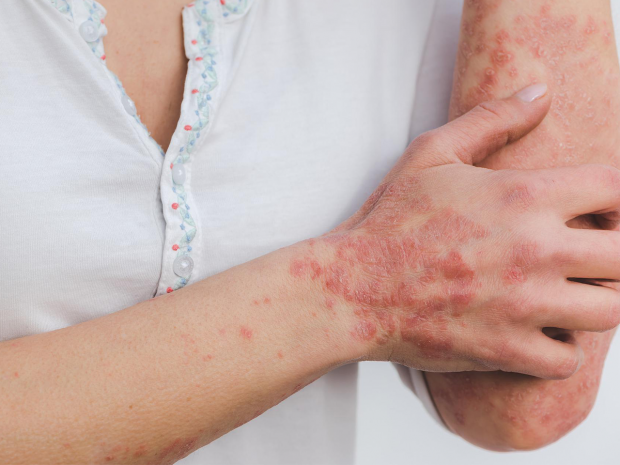 Treat Psoriasis