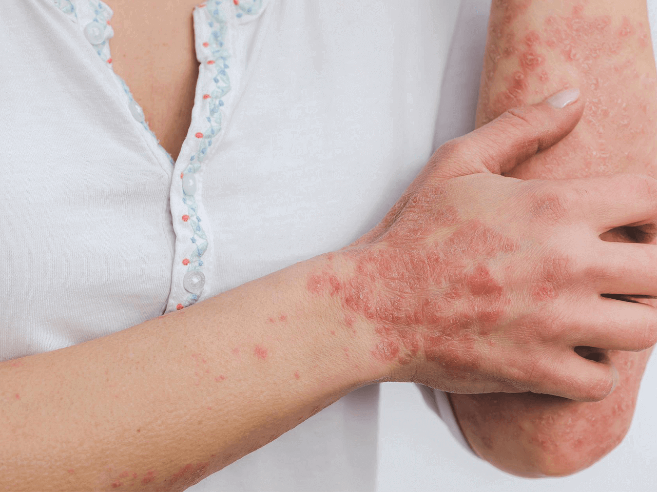 A Dermatologist Explains How To Treat Psoriasis