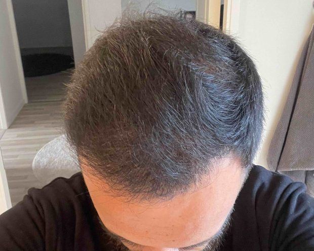 Hair Iransplant