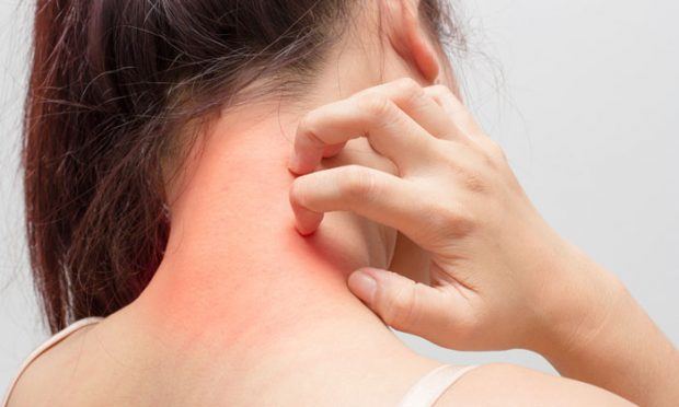 Atopic dermatitis
