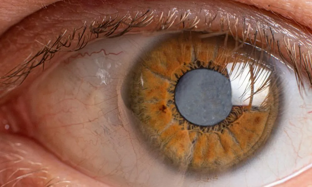 Can Glaucoma Be Treated With A Simple Vitamin?