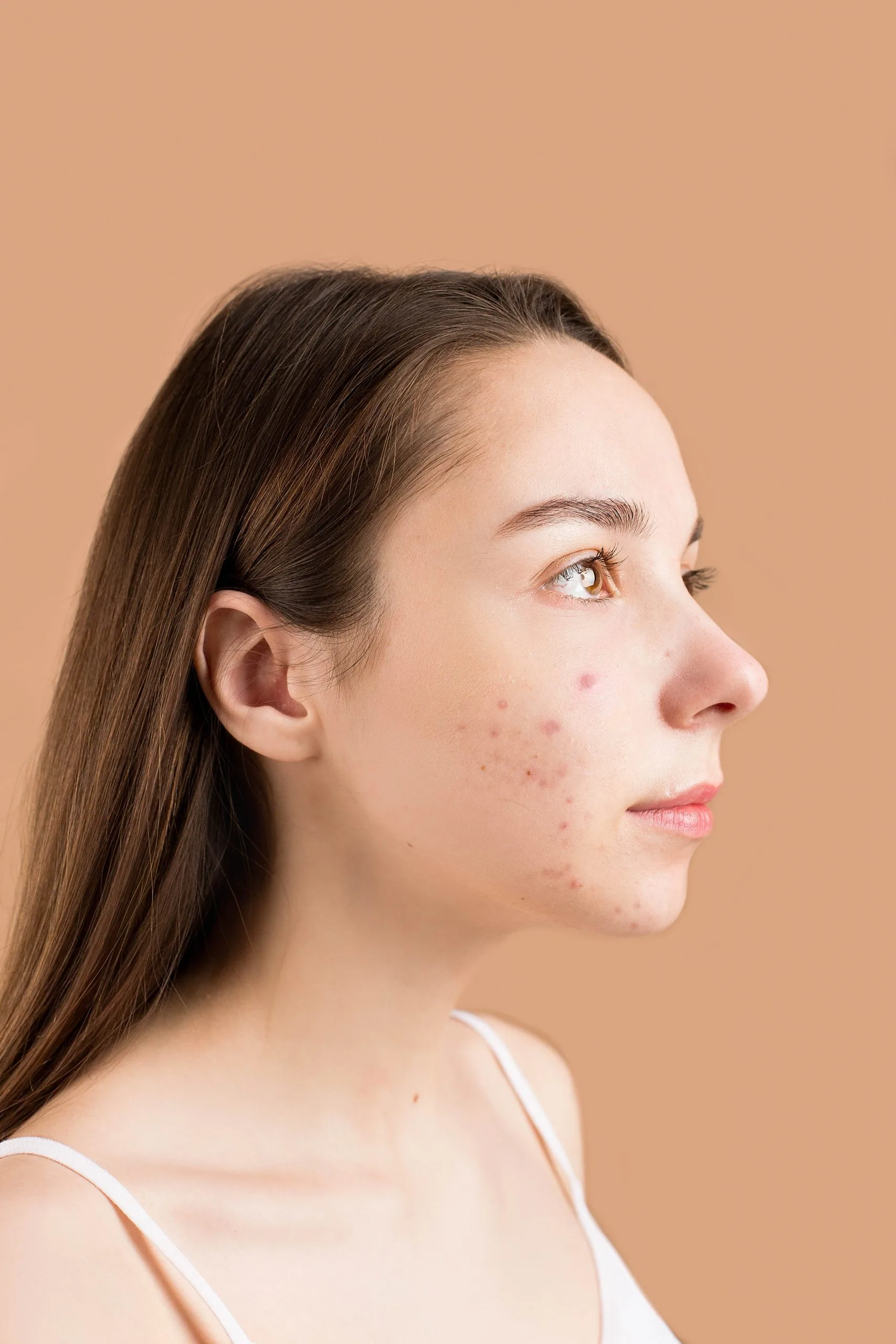 4 Types Of Pimples And How To Treat Them