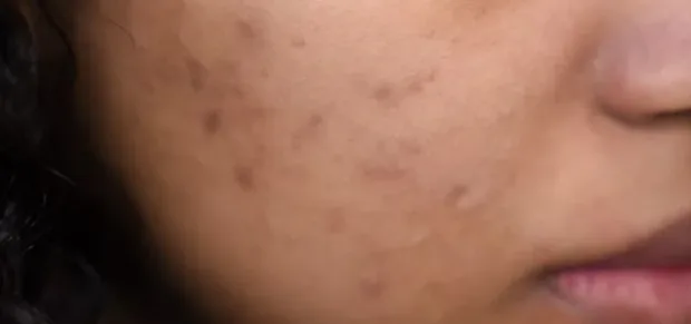 hyperpigmentation