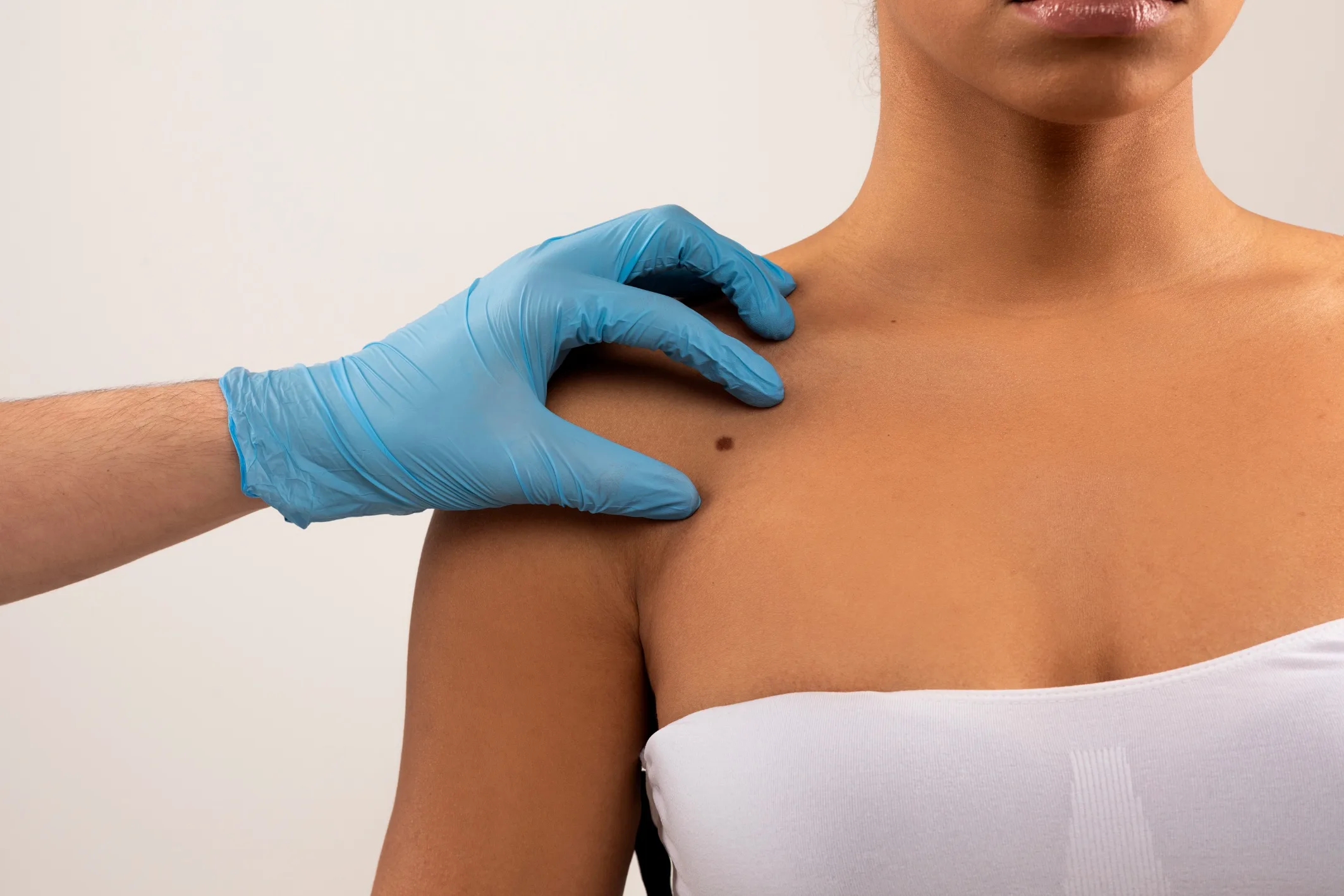 How to Spot Melanoma: The 5 Warning Signs You Should Not Ignore