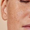 Hyperpigmentation