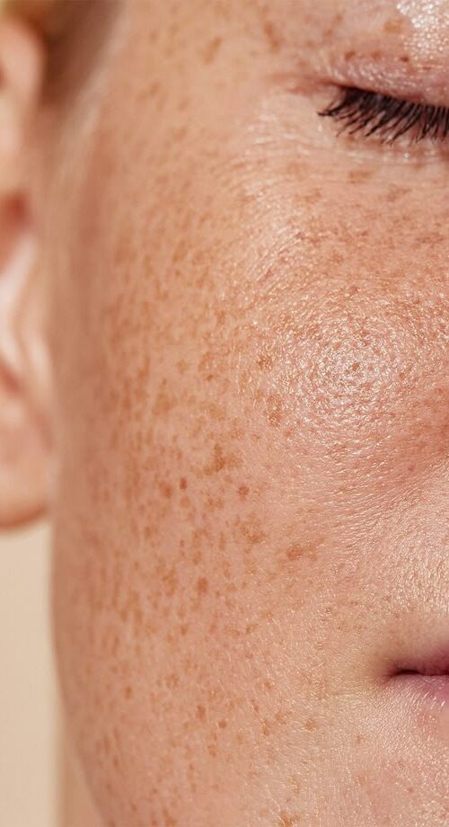 Hyperpigmentation