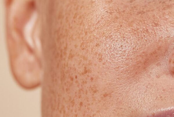 Hyperpigmentation