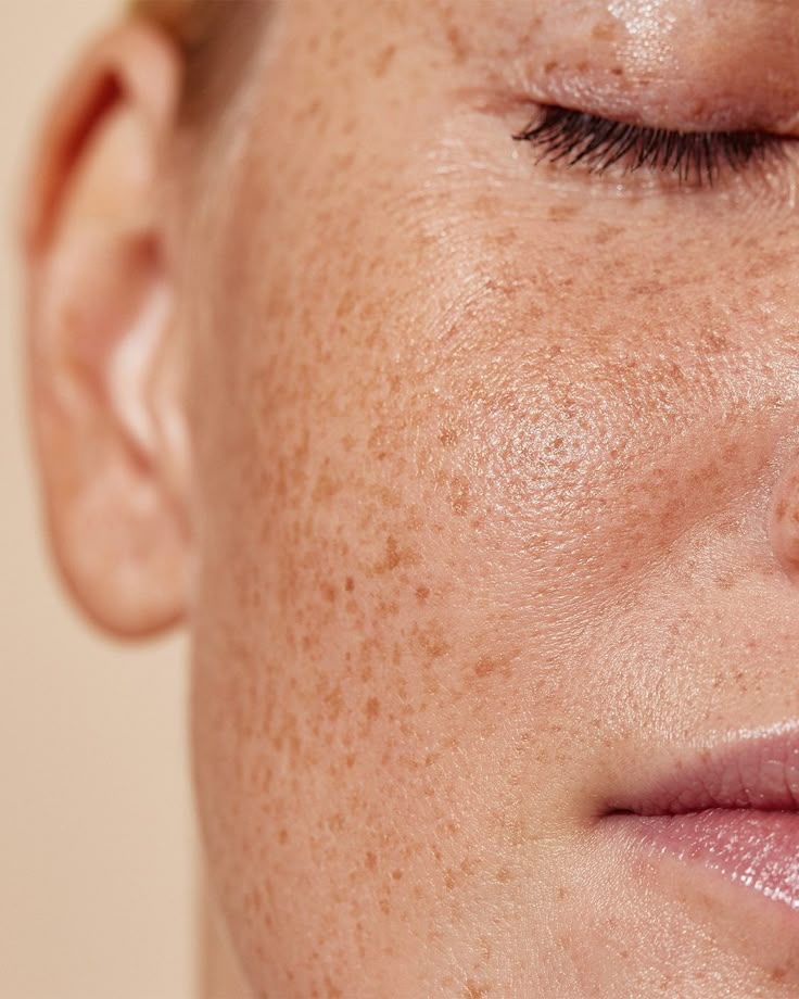 Got Hyperpigmentation? What Is Your Skin Trying To Tell You?