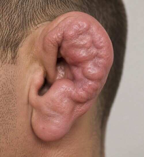 cauliflower ear