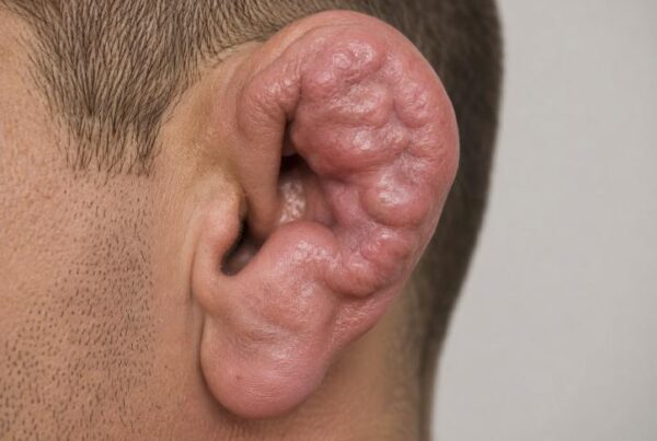cauliflower ear
