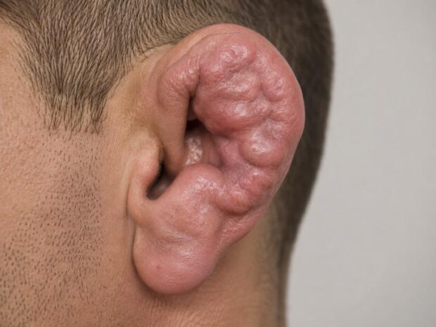 cauliflower ear